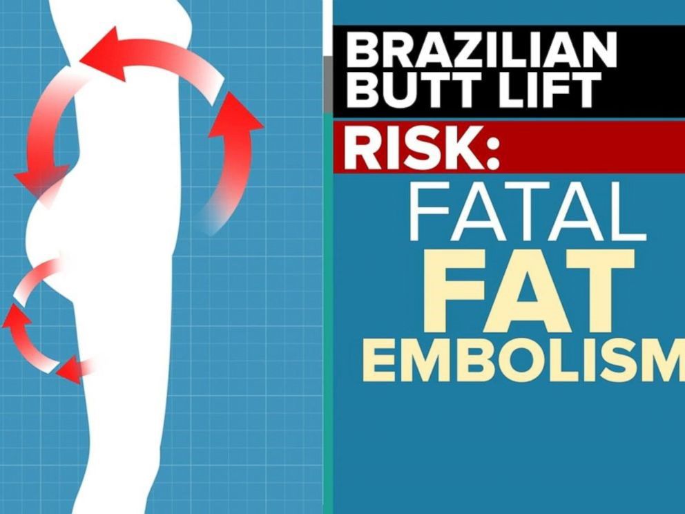 Brazilian butt lift procedure